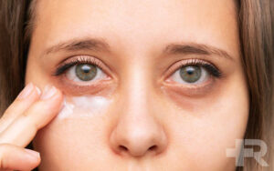 گودی زیر چشم