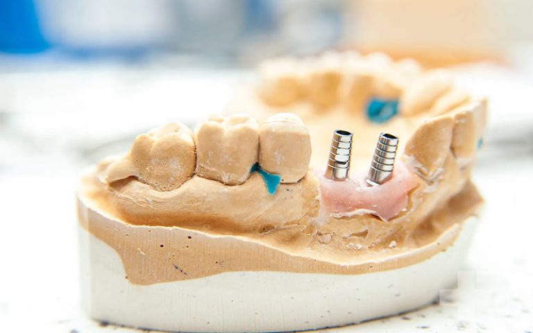 ایمپلنت دندان