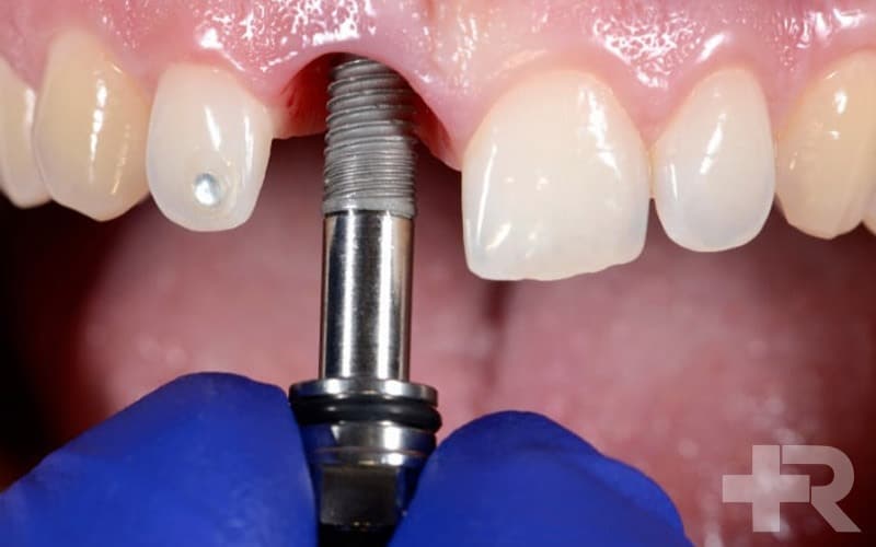 ایمپلنت دندان چیست و چه تاثیری بر زیبایی دندان دارد.