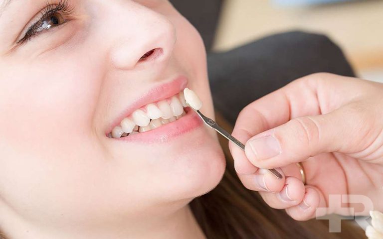 لمینت دندان