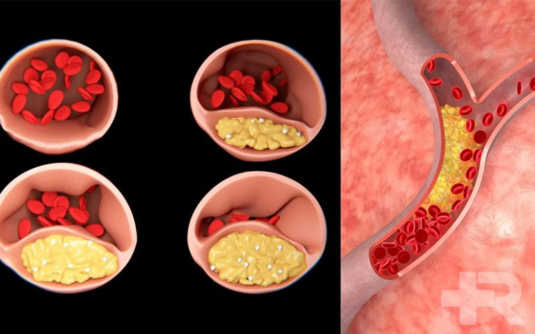 قاتل چربی خون