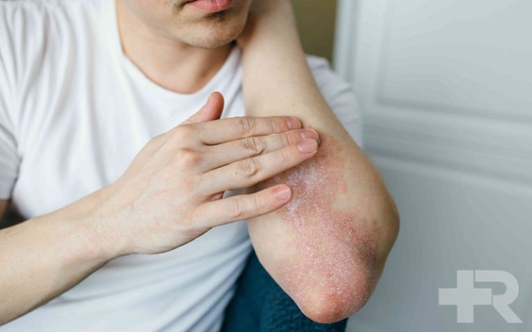 درمان سریع قارچ پوستی