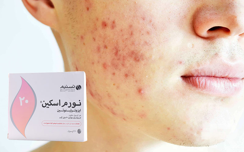 عوارض قرص نورم اسکین 20 چیست؟