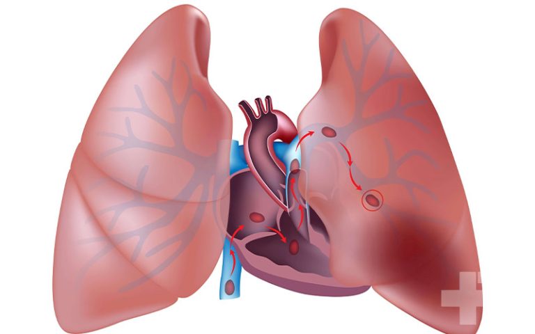 علائم آمبولی ریه