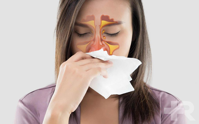 قوی ترین داروی سینوزیت شامل انواع آنتی‌هیستامین و آنتی‌بیوتیک است.