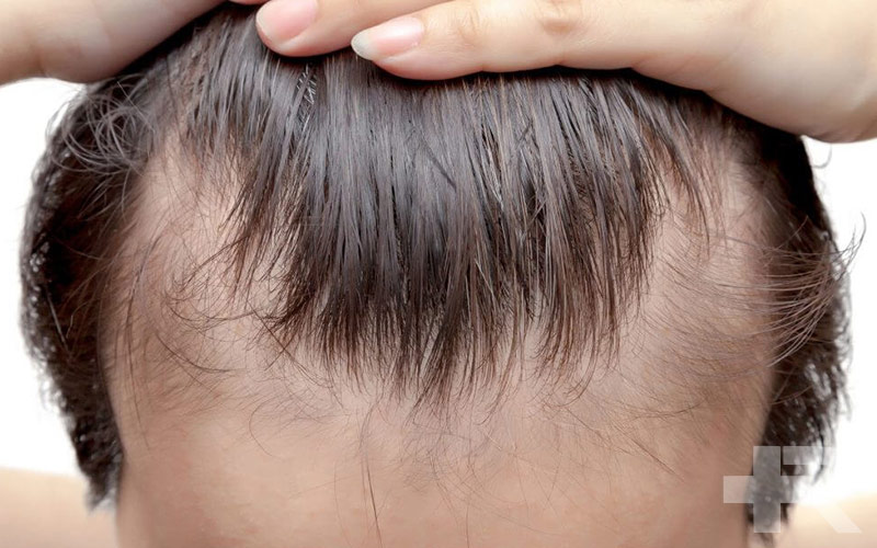 میخک و رزماری برای مو برای مردان و زنان قابل استفاده است و خواص‌های متعددی دارد.