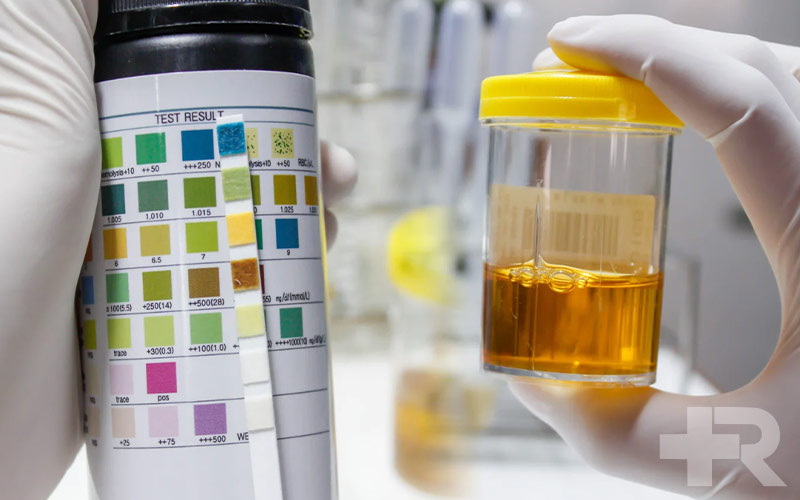 ادرار قهوه ای در مردان و زمان کمی با هم تفاوت دارد که در این مقاله بیان شده است.