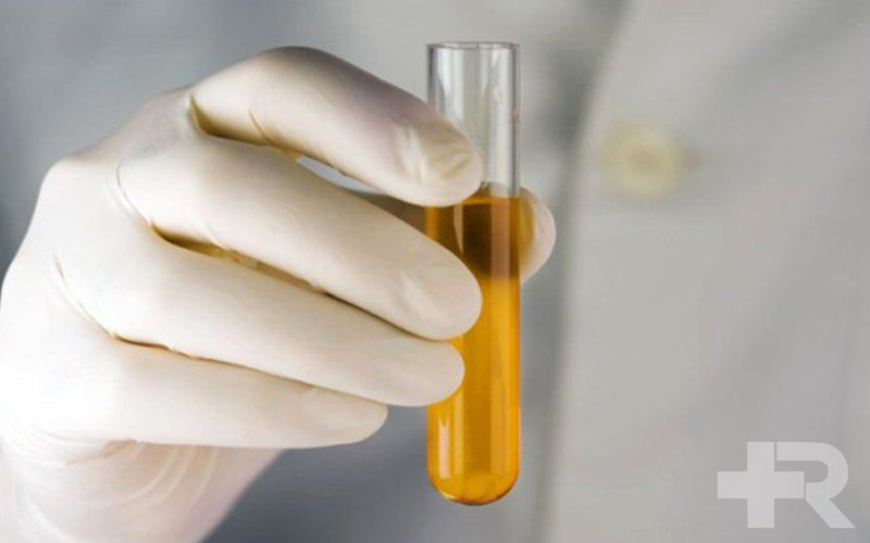 ادرار قهوه ای و سنگ کلیه ارتباط نزدیکی به یکدیگر دارند.