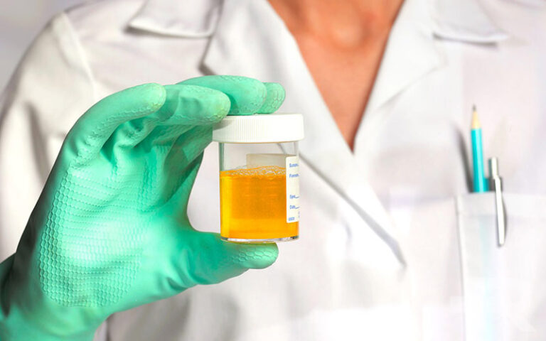 ادرار قهوه ای نشانه چیست؟