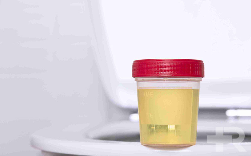 یکی از دلایل ادرار به رنگ آب مربوط به دیابت یا قند خون است.