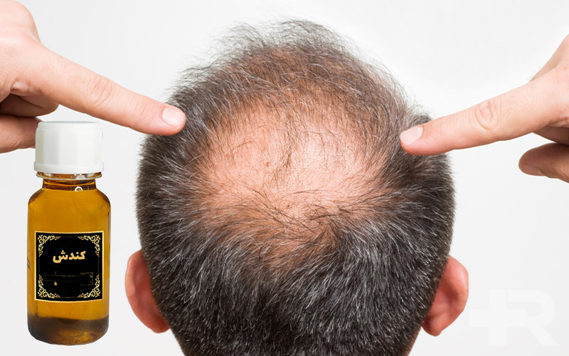 روغن کندش برای انواع کچلی از جمله سکه‌ای کاربرد دارد.