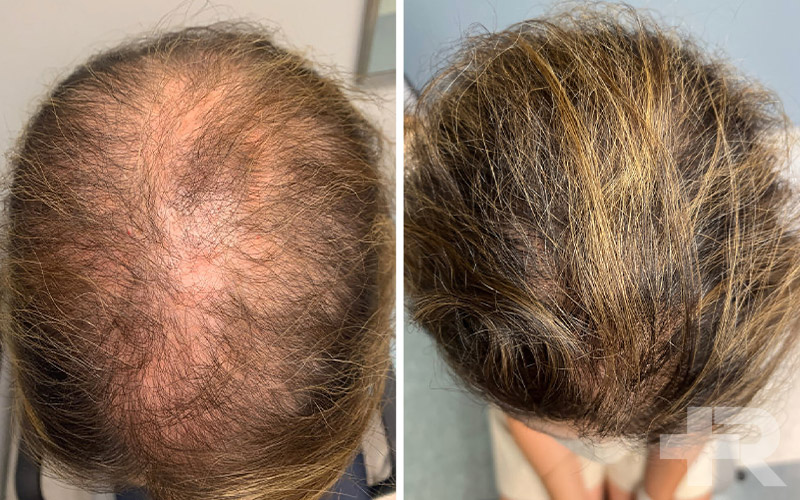 نشانه اثرات روغن کندش برای کچلی، شامل رویش موهای ریز و کرک مانند است.