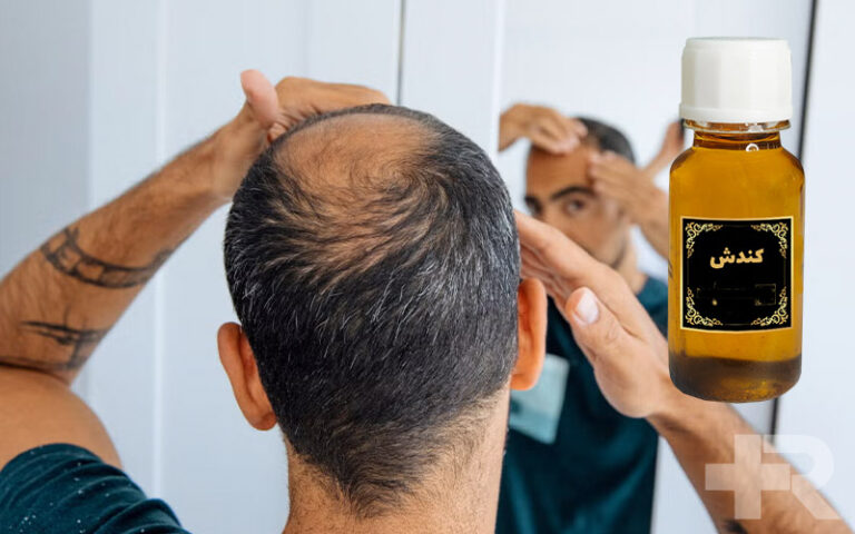 روغن کندش برای کچلی